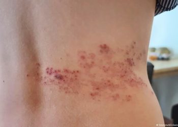 Chega às clínicas privadas no Brasil nova vacina contra herpes-zóster. Mas é cara demais