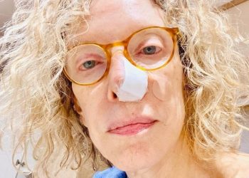 Com câncer de pele no nariz, Marília Gabi  Gabriela dá um conselho: Usem filtro solar