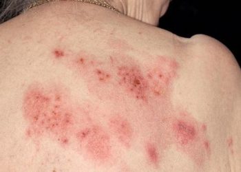 Após os 50, é preciso saber tudo da  herpes-zóster ou ‘cobreiro’
