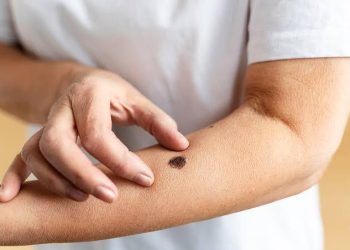 Câncer de pele é mais comum acima dos 40