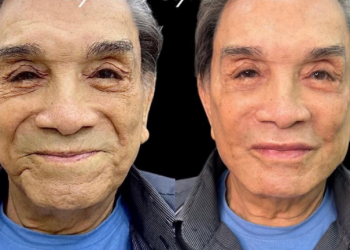Harmonização facial aos 86 anos?