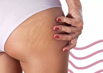 Por que nossas avós não tinham estrias