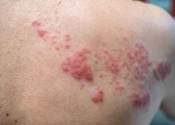 SUS dá início a processo para oferecer vacina contra herpes-zóster em sua rede