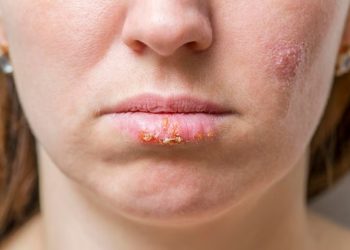 Herpes-zóster, doença que pode até matar, cresce entre maiores de 50
